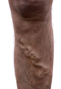 Varicose veins legs.jpg