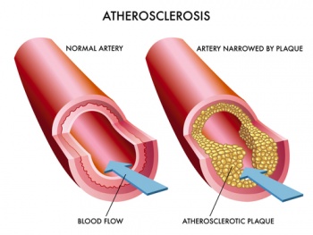 Atherosclerosis diagram.jpg