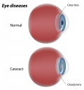 Cataracts.jpg
