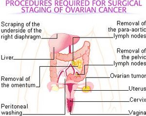 Ovarian cancer staging.jpg