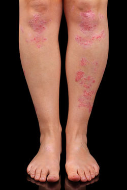 Psoriasis knee.jpg