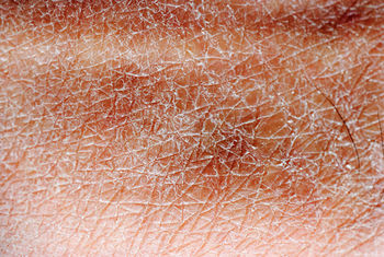 Dry skin.jpg