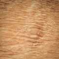 Dry skin2.jpg