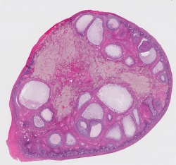 Ovarian cysts.jpg