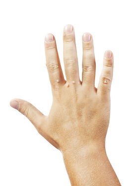 Warts hand.jpg