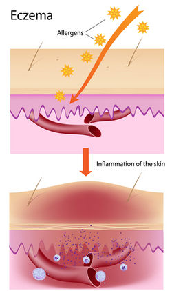 Eczema diagram.jpg