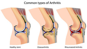 Arthritis diagram.jpg
