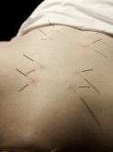 Acupuncture needling.jpg