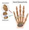 Osteoarthritis.jpg