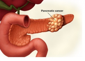 Pancreatic-Cancer.jpg