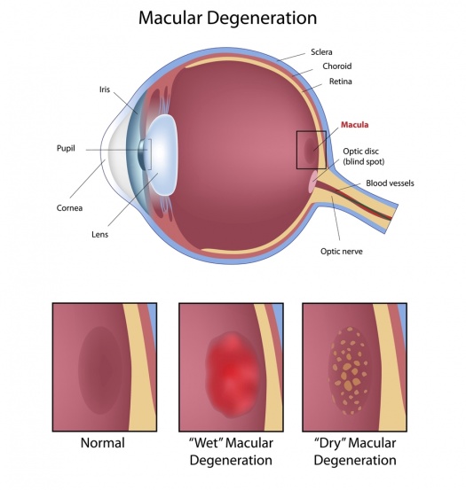 Macular Degeneration Health Facts