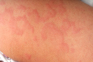 Hives allergic.jpg