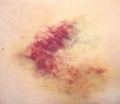 Bruises.jpg