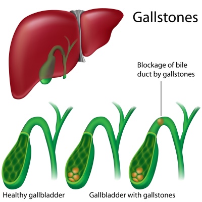Cholelithiasis Cholelithiasis (Gallstones)