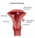 Uterine fibroids.jpg